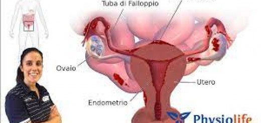 endometriosi immagine 3