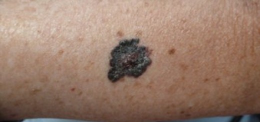 Melanoma cutaneo immagine 5